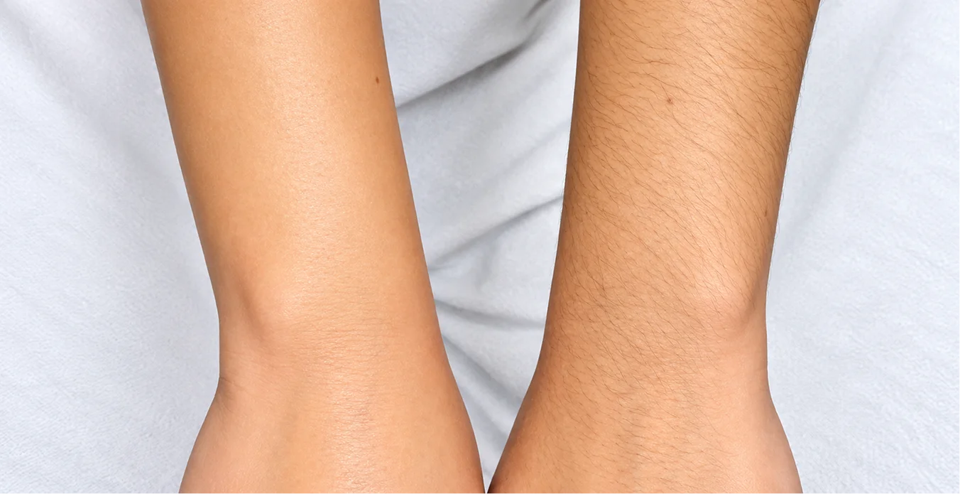 Laser Hair Removal in Chennai